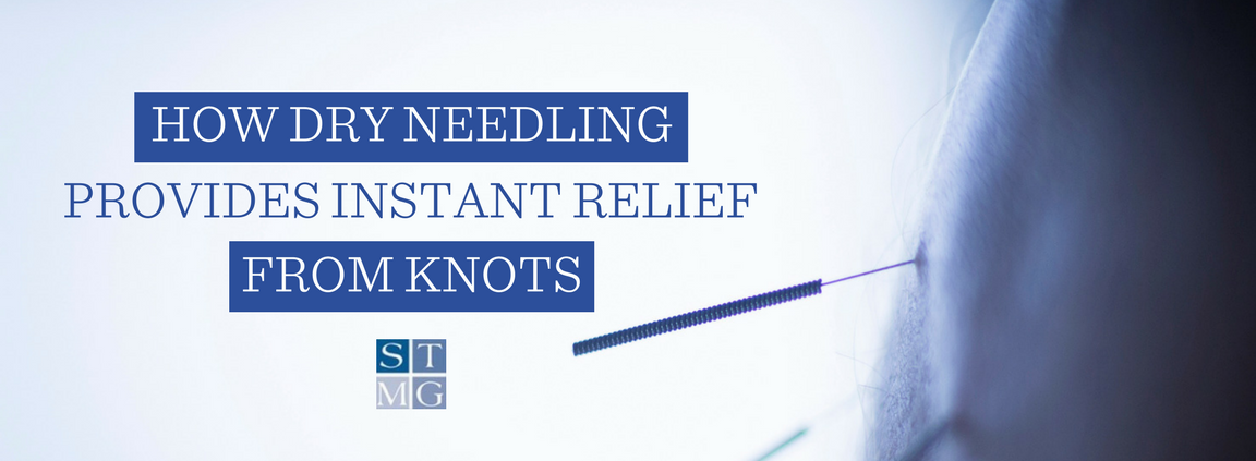 dry needling relief from knots